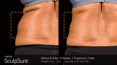 BA SculpSure B Katz Post1Tx 12weeks