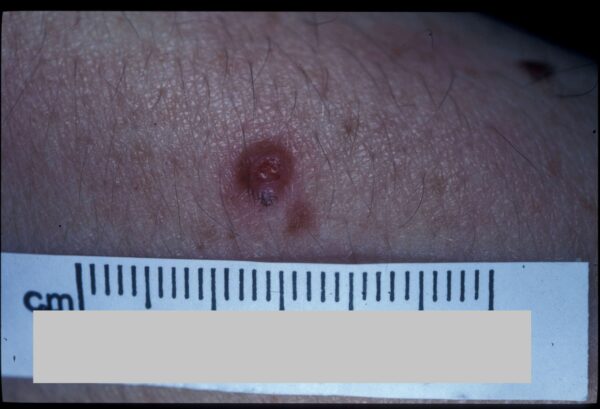 Melanoma - Skin Cancer Removal and Treatment | Brisbane