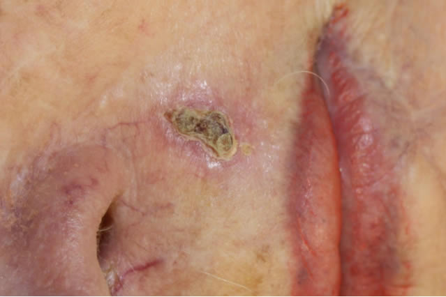 infiltrative basal cell carcinoma