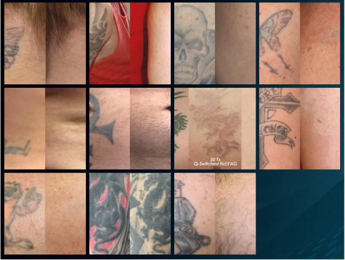 How to remove a tattoo at home with manganese? : r/TattooRemoval