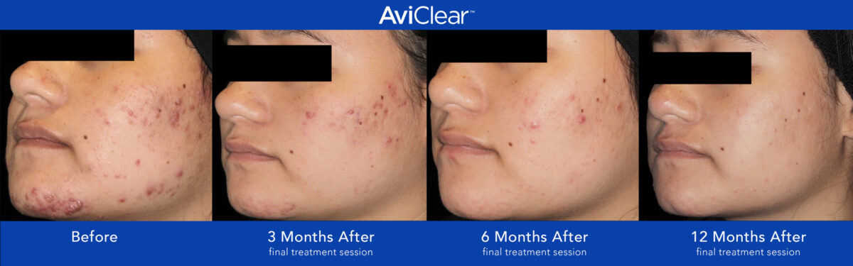 AviClear Acne Laser Treatment Brisbane | Aesthetix